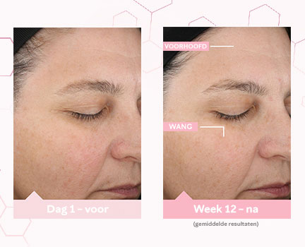 Voor-en-na foto's van dag 1 en week 12 die de gemiddelde huidverbetering op het voorhoofd laten zien na het aanbrengen van de TimeWise® "wonderkit