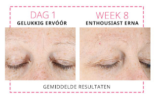 In een directe vergelijking zie je de fronsrimpel tussen de wenkbrauwen van een vrouw op dag 1 en week 8 sinds de vrouw Mary Kay Clinical Solutions™ Dynamic Wrinkle Limiter begon te gebruiken. De foto's tonen gemiddelde resultaten.