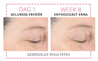 In een directe vergelijking zie je de kraaienpootjes/verlengde lachrimpels op de slapen van een vrouw op dag 1 en week 8 sinds de vrouw Mary Kay Clinical Solutions™ Dynamic Wrinkle Limiter begon te gebruiken. De foto's tonen gemiddelde resultaten.