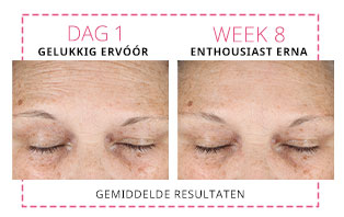 Een directe vergelijking toont de voorhoofdrimpels (expressielijntjes) van een vrouw op dag 1 en in week 8, sinds de vrouw de Mary Kay Clinical Solutions™ Dynamic Wrinkle Limiter gebruikt. De foto's tonen gemiddelde resultaten.